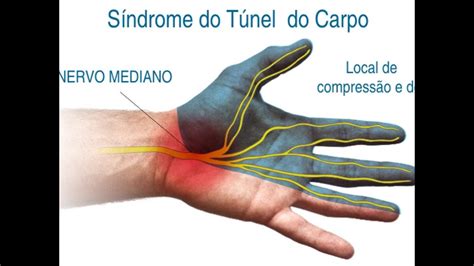 Síndrome Do Túnel Do Carpo O Que É Causas Sintomas Tratamento Clínica