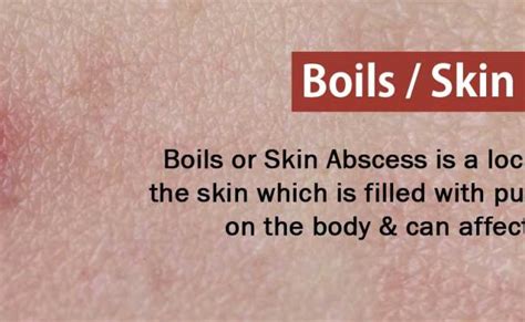 Skin Abscess Causes Diagnosis Symptoms Treatment Prognosis Otosection