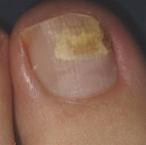 Fungal Nail Infections Causes Symptoms Treatment Fungal Nail Infections