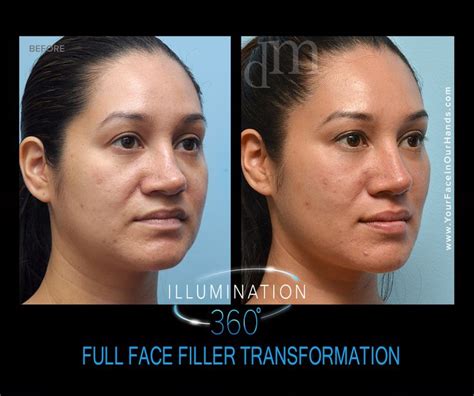 Before And After Photos Of Non Surgical Facial Rejuvenation And Contouring