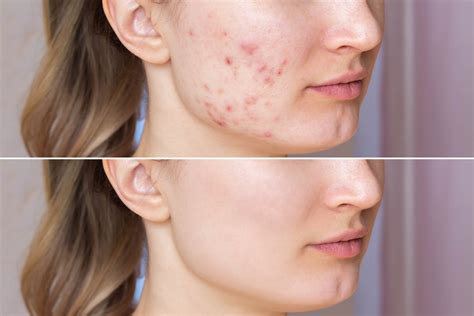 How To Get Rid Of Acne Scars Treatments And Home Remedies