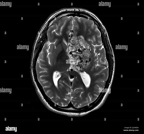 Subarachnoid Hemorrhage MRI Scan Stock Photo Alamy