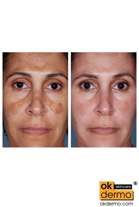 Tri Luma For The Treatment Of Post Inflammatory Hyperpigmentation