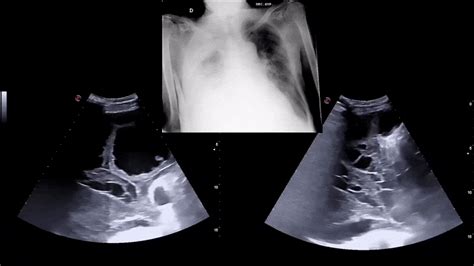 Loculated Pleural Effusion On Ultrasound Tuberculous Pleural Effusion