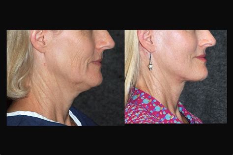 Deep Plane Facelift Before And After Dr Andrew Jacono Plastic Surgery Facelift Facial