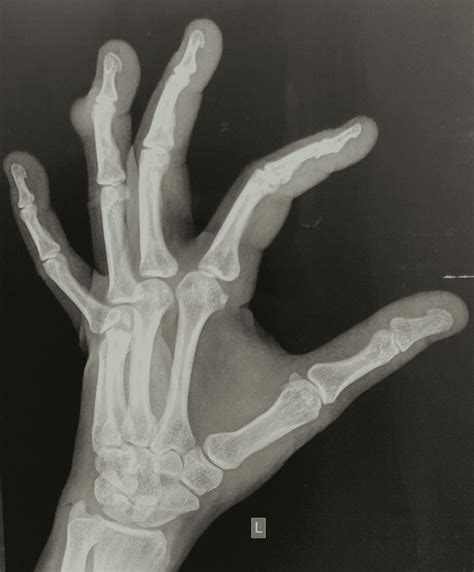 Cureus Giant Cell Tumor Of Extensor Tendon Sheath In Ring Finger A