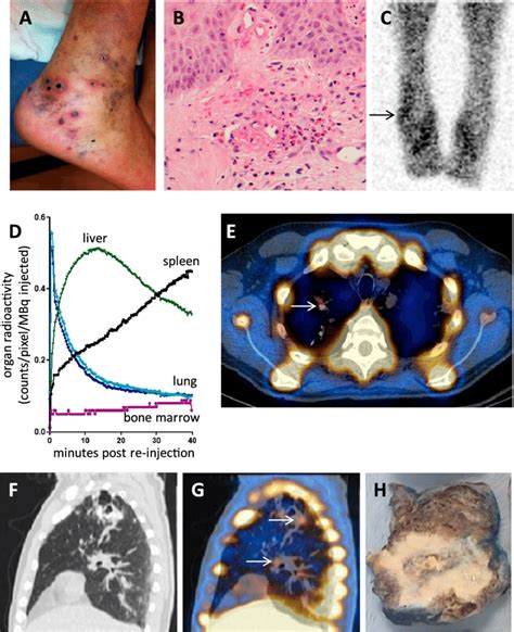 Technetium 99mlabeled Eosinophil Scanning In Granulomatosis With