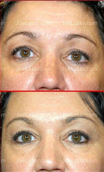 Botox Eyebrow Lift Treatment Before And After Facial Injections Info