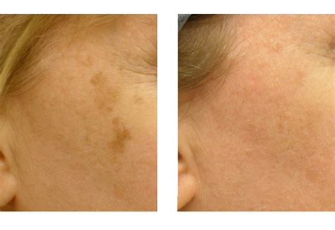 Brown Spots Age Spots And Tattoo Removal San Diego Dermatology And