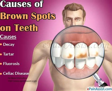 Causes Of Brown Spots On Teeth Teeth Stained Teeth Oral Health