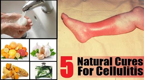 5 Home Remedies To Get Rid Of Cellulitis Infection By Top 5 Youtube