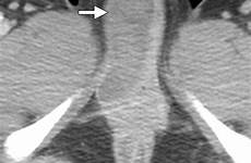 perineum female figure hematoma imaging adults contrast labial