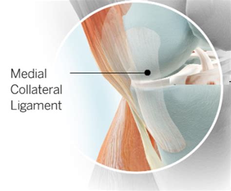 Medial Collateral Ligament Tear Mcl Treatment Drraj Kanna