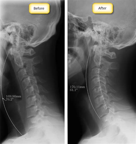 Relief From Neck Pain And Normalization Of The Cervical Curve With