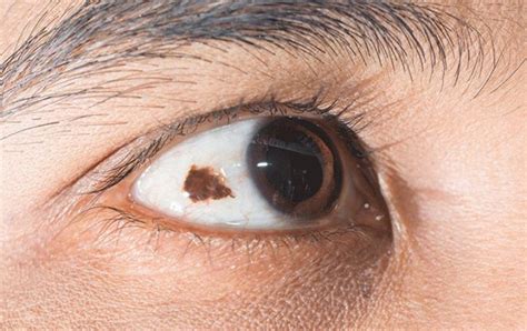 Conjunctival Nevus A Benign Growth On The Eyes Surface Obn