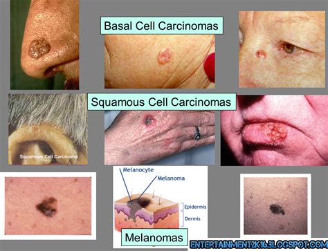 Skin Cancer Pictures Most Common Skin Cancer Types With Images Images