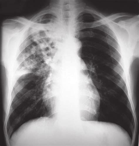 Chest X Ray Showing An Infiltrative Lesion And Cavitation In The Right Images