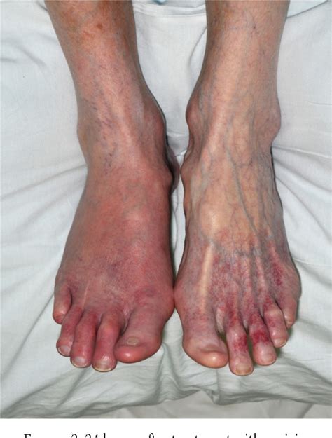 Figure 1 From Erythromelalgia An Uncommon Presentation Precipitated By