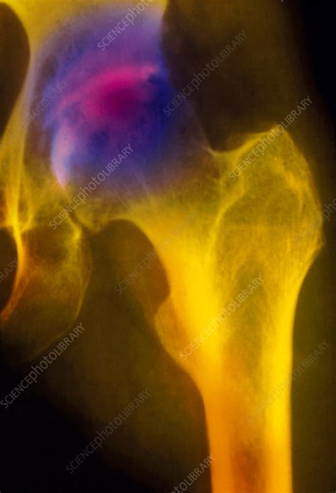 Coloured X Ray Of Osteoarthritis In A Hip Joint Stock Image M110