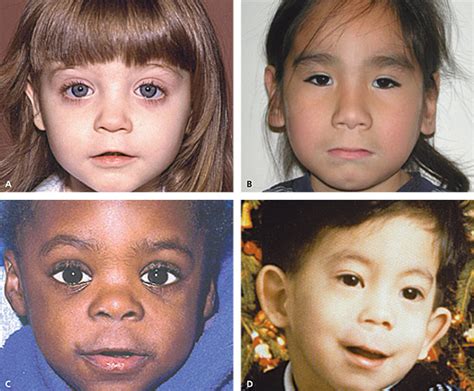 I am partly asian,i have almond shaped eyes and stretchy lids but i do not have a monolid or epicanthical fold as you can see. Fetal Alcohol Spectrum Disorders - - American Family Physician