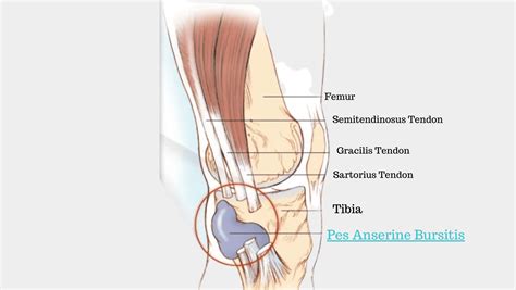 Pes Anserine Bursitis Pes Anserine Bursitis Exercises