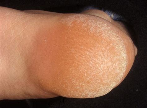 Callus Dermatology Conditions And Treatments
