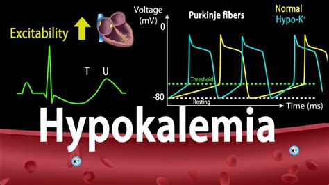 Hypokalemia Causes Symptoms Effects On The Heart