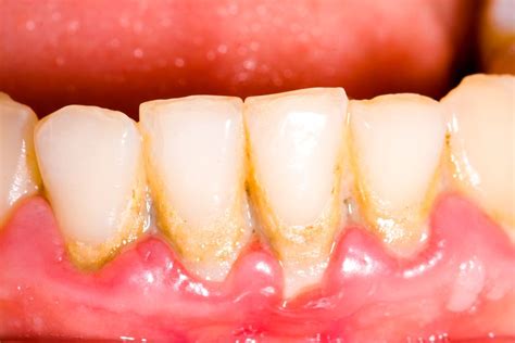 Gingivitis Periodontitis Symptoms Treatment Of Gum Disease Live