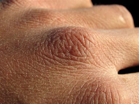 How To Heal Dry Cracked Hands And Avoid Having Them In The First