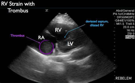 Diagnosis Of Right Ventricular Strain With Transthoracic