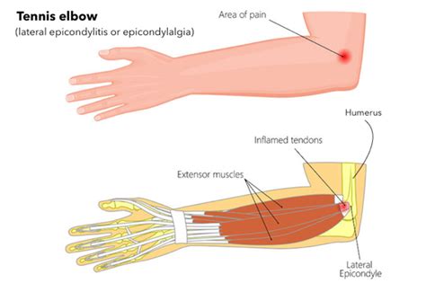 Tennis elbow causes and risk factors. Tennis Elbow: An Essential Injury Guide - AskTheTrainer.com
