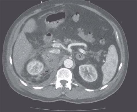Ct Abdomen Showing Bilateral Adrenal Masses With Extensive Right