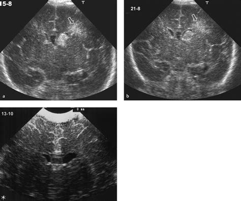 3 Neonatal Cranial Ultrasonography Radiology Key