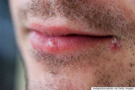 Herpes Virus Could Successfully Treat Skin Cancer Study Suggests