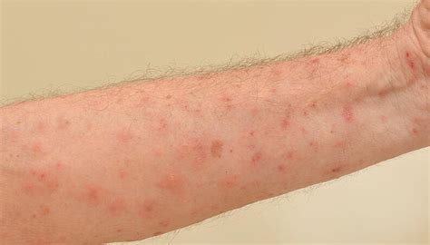 A escabiose é uma infecção parasitária da pele. Sarna também afeta humanos: o que é, como pega, sintomas e ...