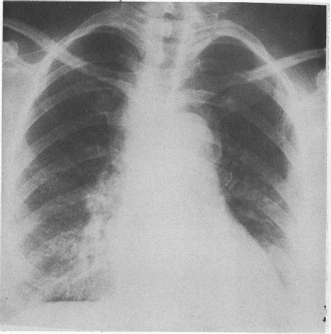 Chest Radiograph At Presentation Showing Interstitial Infiltrate In The