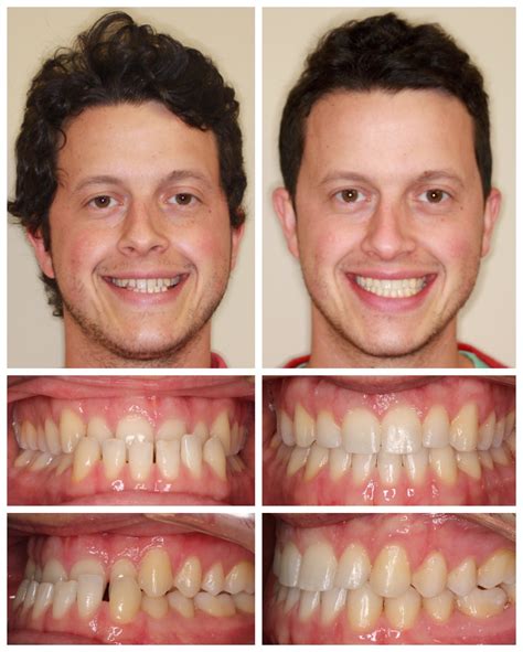 Before And After In Guilford East Haven And Hamden Ct Dobie Revolution Orthodontics