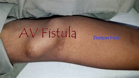 Fistula For Dialysis Dialysis Access Av Fistula Youtube