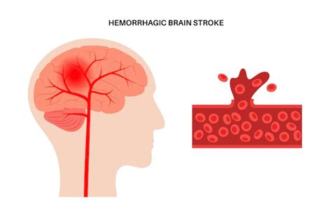 Treatment Of Hemorrhagic Stroke Health Journal