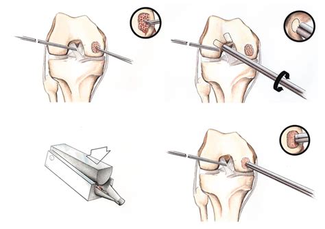 Articular Cartilage Repair Options For Arthritic Knees
