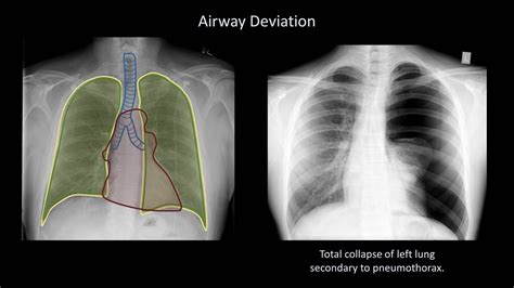 How To Interpret A Chest X Ray Lesson 4 Airways Bones And Soft