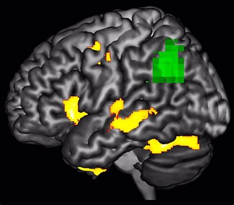 Investigadores Hallan Una Nueva Forma De Detectar La Neurodegeneración