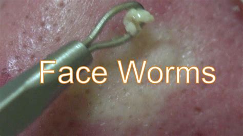 Face Worms Life With Cystic Acne Documentary 33 Cystic Acne Face Acne