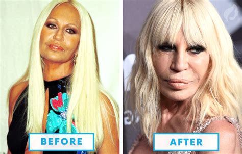 Celebrities With Plastic Surgery Plastic Industry In The World
