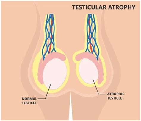 Testicular Atrophy Understanding The Shrinkage Of Male Reproductive Power