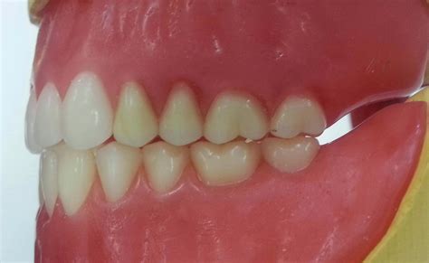 Mrs Ds Dental Technology Space For Student Posterior Occlusion