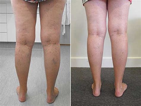 Spider Vein Removal Before And After Photos Palm Clinic