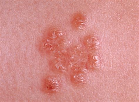 Progressive Diffuse Papules In A Child—quiz Case Dermatology Jama