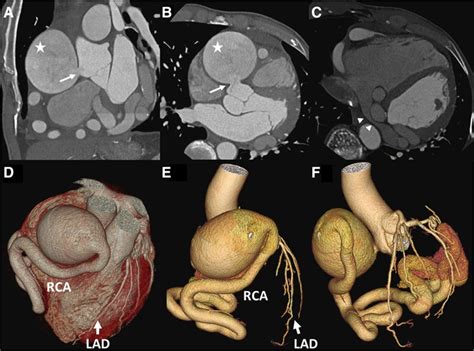 Multimodality Imaging Of Giant Right Coronary Aneurysm And Postsurgical Coronary Artery