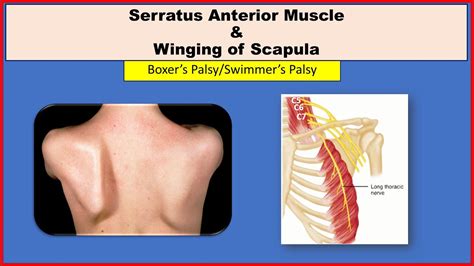 Winging Of Scapula Anatomy Serratus Anterior Muscle Long Thoracic